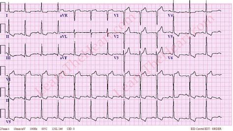 ecg lv strain